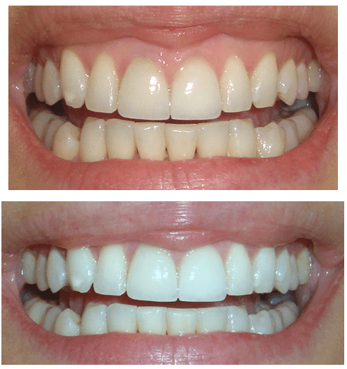 whiten-teeth-crest-white-strips-before-after